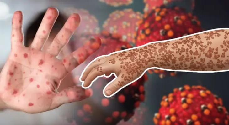 হামের প্রাদুর্ভাব বাড়ছে উৎকন্ঠাজনক হারে  : ভয়াবহতা রোধে করণীয় 